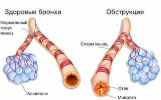 Всё об обструктивном бронхите у детей: симптомы, возможности лечения в домашних условиях, опасность болезни