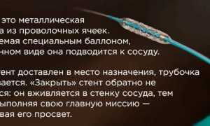 Все о стентировании сосудов сердца