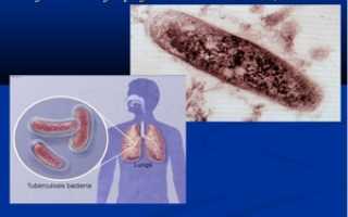 Диссеминированный туберкулез легких — риск заражения