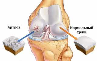 Эффективное лечение артроза коленного сустава лазером
