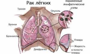 Мелкоклеточный рак легких: характеристика, стадии и прогноз