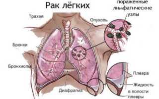 Мелкоклеточный рак легких: характеристика, стадии и прогноз