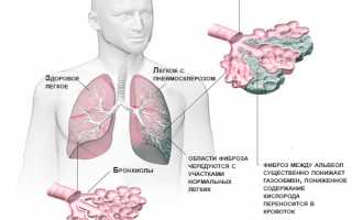 Что такое пневмосклероз легких, его причины, симптомы и лечение