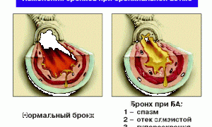 Обследование при бронхиальной астме