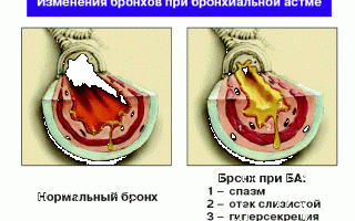 Обследование при бронхиальной астме