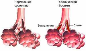 Прогревания при бронхите у детей и взрослых