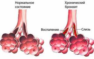 Прогревания при бронхите у детей и взрослых