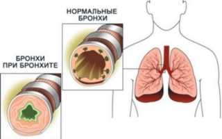 Актуальные вопросы применения сиропа Флавамед в лечении кашля у детей