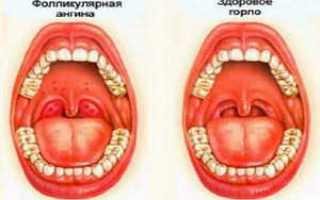 Фолликулярная ангина – особенности течения болезни