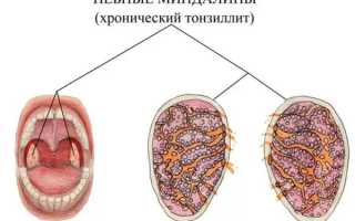 Симптомы, клинические рекомендации и меры профилактики хронического тонзиллита