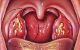 Почему на миндалинах появляется белый налёт и как его убрать