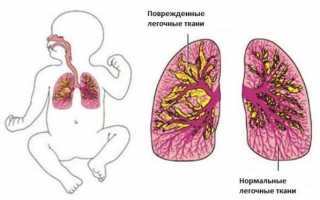 Опасная и необратимая бронхолегочная дисплазия у детей: почему возникает, клинические рекомендации, последствия