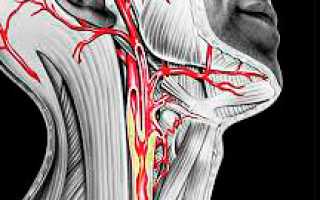 Атеросклероз шейных сосудов: симптомы и лечение