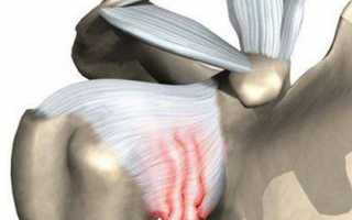 Адгезивный капсулит плеча: стадии, симптомы и лечение