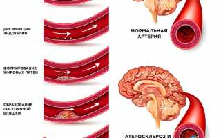 Атеросклероз головного мозга — полное описание заболевания. Методы лечения и диагностики