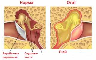 Как лечить отит уха перекисью водорода
