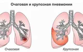 Симптомы, лечение и возможные осложнения очаговой пневмонии у взрослых больных