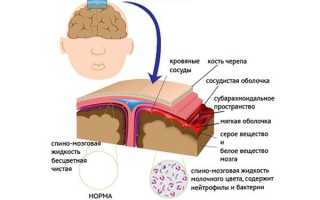 Что такое менингит, как он передаётся, каково лечение и возможные последствия болезни?