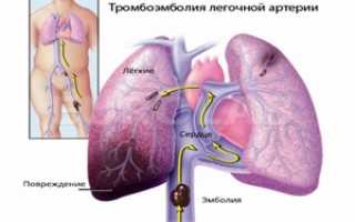 ТЭЛА – оказание первой неотложной помощи