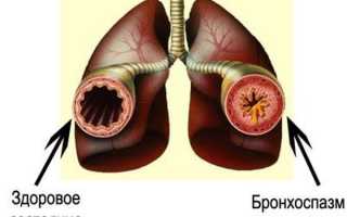 Почему возникает бронхоспазм, какими симптомами проявляется и как лечится у взрослых и детей