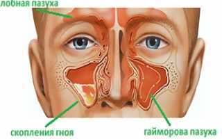 Что такое  хронический гайморит, симптомы и лечение у взрослых