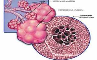 Что такое буллезная эмфизема легких, её причины, симптомы и лечение