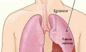 Туберкулезный плеврит: симптомы, диагностика и лечение