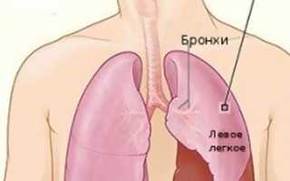 Туберкулезный плеврит: симптомы, диагностика и лечение