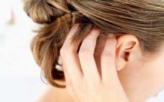 Перхоть и выпадение голос – симптомы грибка кожи головы