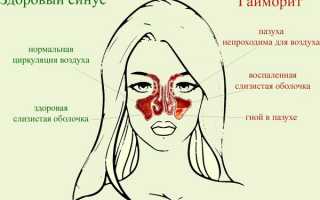 Почему насморк сопровождается выделением крови и что делать в этом случае?