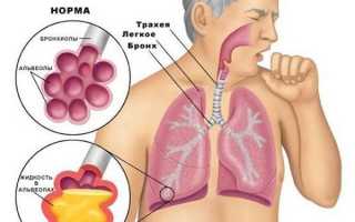 Бывает ли пневмония без кашля и по каким симптомам её можно определить