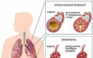 Основные симптомы (признаки) хронической обструктивной болезни легких (ХОБЛ)