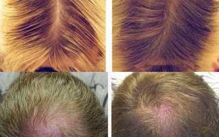 Плюсы мезотерапии для роста волос