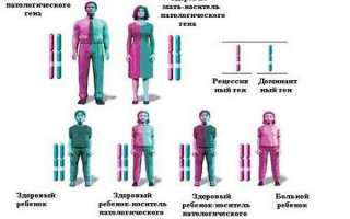 Муковисцидоз – потенциально летальное заболевание