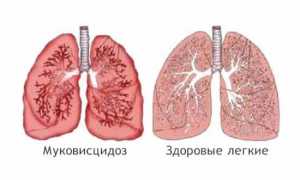 Муковисцидоз у детей: симптомы, диагностика и лечение