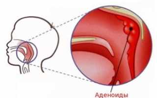 Способы лечения аденоидов у детей: лекарства, процедуры, народные средства, операция