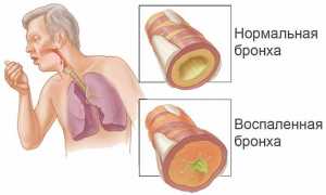 Диффузный бронхит: симптомы и лечение