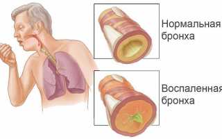 Диффузный бронхит: симптомы и лечение