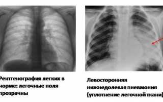 Как проявляется, сколько лечится левосторонняя пневмония и можно ли курить при этой болезни