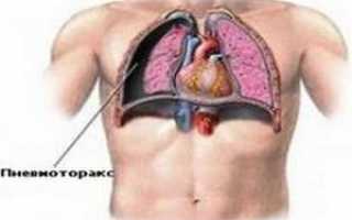 Насколько опасен закрытый пневмоторакс и как спасти больного?