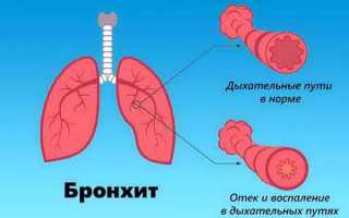 Чем лечить кашель у грудничка: сиропы внутрь, мази для растирания, постуральный массаж