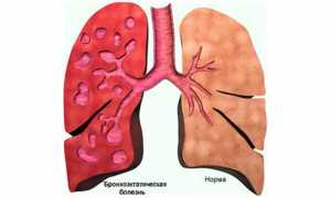 Бронхоэктатическая болезнь: симптомы, диагностика и лечение