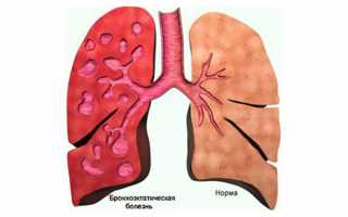 Бронхоэктатическая болезнь: симптомы, диагностика и лечение