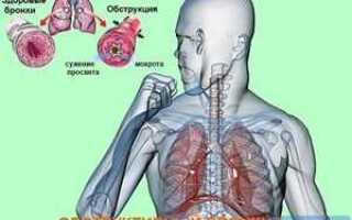 Что такое обструктивный бронхит, как определить его симптомы и вылечить