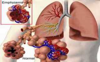 Что такое эмфизема легких и как она лечится