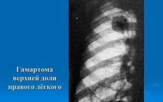 Гамартома легкого – причины, симптомы, лечение