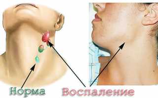 Туберкулез лимфоузлов: симптомы, диагностика и лечение