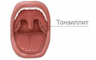 Что такое тонзиллит, его симптомы и лечение