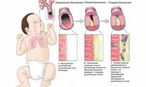 Бронхиолит у детей: причины, симптомы и лечение