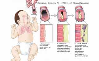 Бронхиолит у детей: причины, симптомы и лечение
